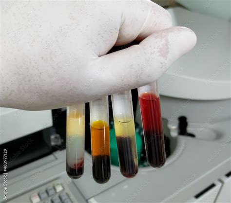 Common types of blood serum sample errors. Different types of sample ...