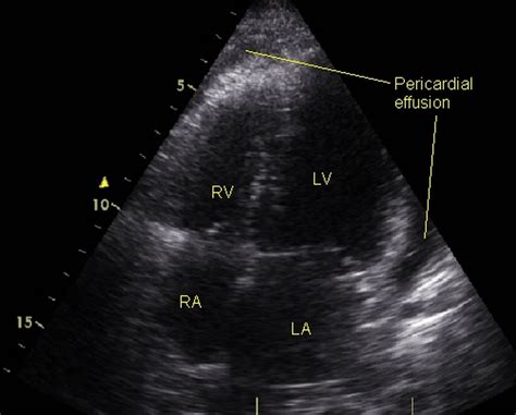 Mild pericardial effusion on echocardiography - seen as echo free space