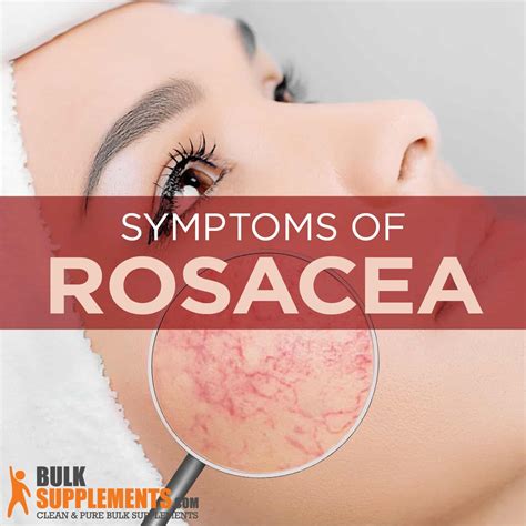 Rosacea: Symptoms, Causes & Treatment