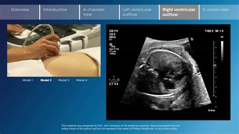 Key screening views of the fetal heart - Part 5 - Right ventricular outflow - YouTube