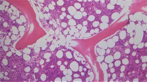 How to read your bone marrow report | MyPathologyReport.ca