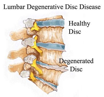 Degenerative Disk Disease Treatment NYC, Osteoarthritis Doctors Specialists