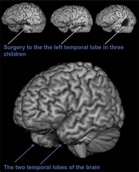 Pin on EPILEPSY BRAIN SURGERY