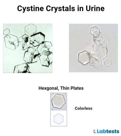 Urinary Crystals: Types, Causes, and Clinical Significance