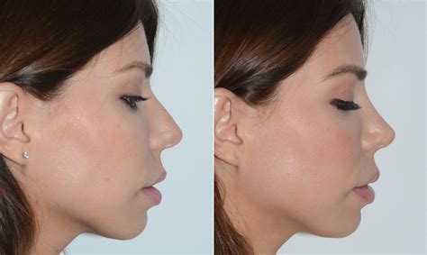 Rhinoplasty photos | Miami, FL. | Patient 19609