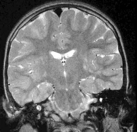 b. Subtle mineralizing microangiopathy in a 10-year-old girl who had ...