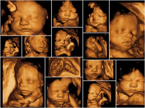 3D & 4D Fetal Scans - Dr Aarti Govardhane