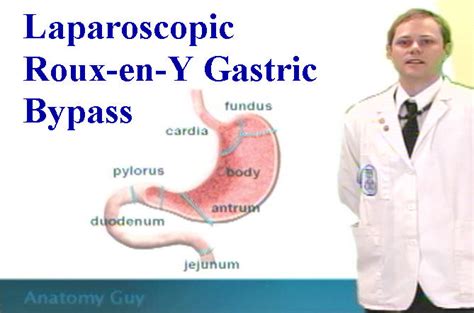 Laparoscopic Roux-en-Y Gastric Bypass - Anatomy Guy