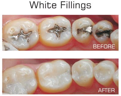 The Windsor Dental Blog: White Fillings Vs Silver Fillings