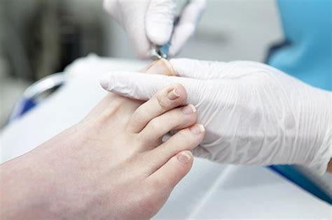 Toe Nail Surgery | Worthing | Manos Foot Clinic