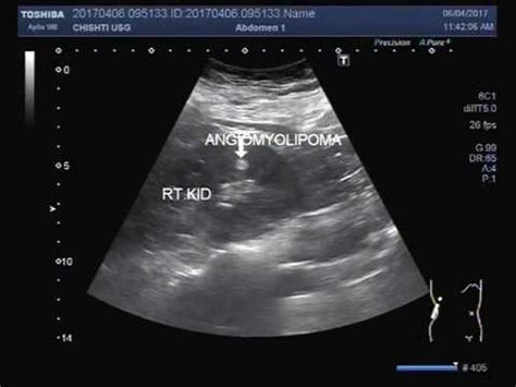 Ultrasound Video showing Renal Angiomyolipoma. - YouTube