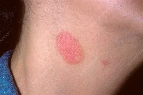 Ringworm fungal infection - Stock Image - C034/8796 - Science Photo Library