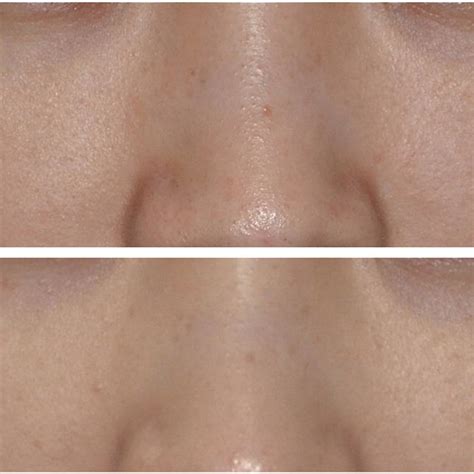 Clinical pictures of a subject with Hori’s nevus with blue-brown ...