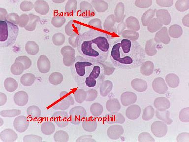 Band cells or band neutrophils and left shift | Medical Laboratories