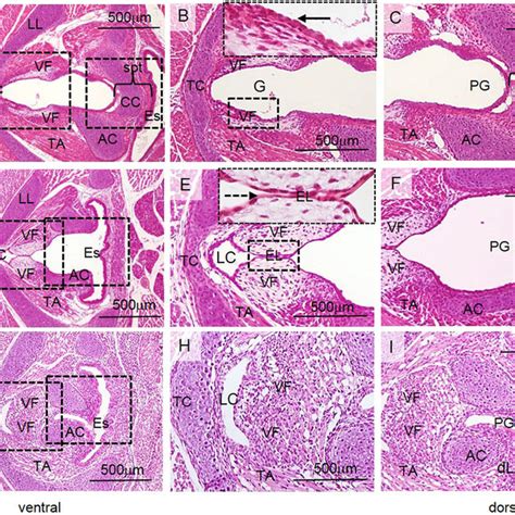 Figure S1: Laryngeal webs in humans. Unseparated VFs block the entrance ...