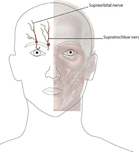 Nerve Blocks - Headache Treatments