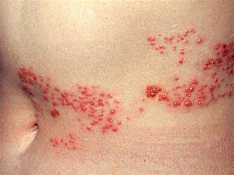 Is it shingles? 7 myths about painful illness (graphic images) - Photo 1 - Pictures - CBS News