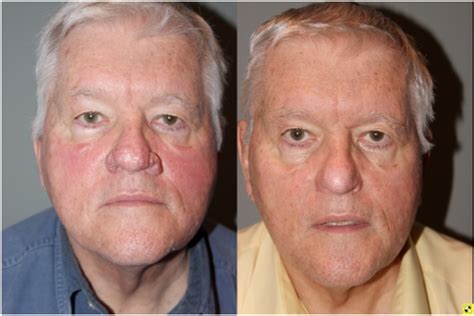 🥇 Atlanta Rhinophyma Treatments | Buckhead Severe Rosacea Specialist