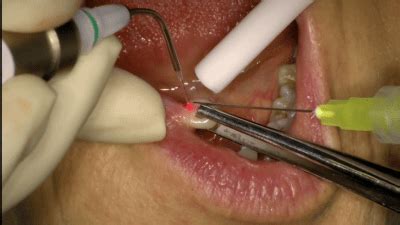 Laser Assisted Removal Irritation Fibroma - PerioHome