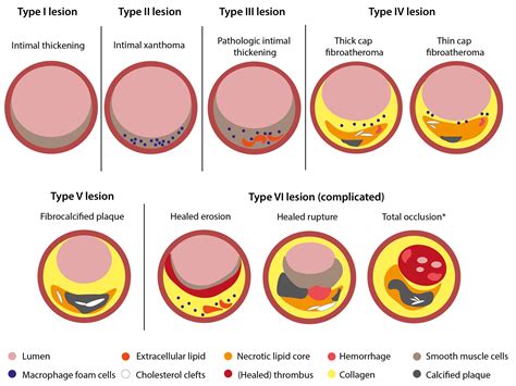 Identification and treatment of the vulnerable coronary plaque