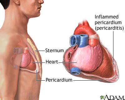 Pericarditis: MedlinePlus Medical Encyclopedia