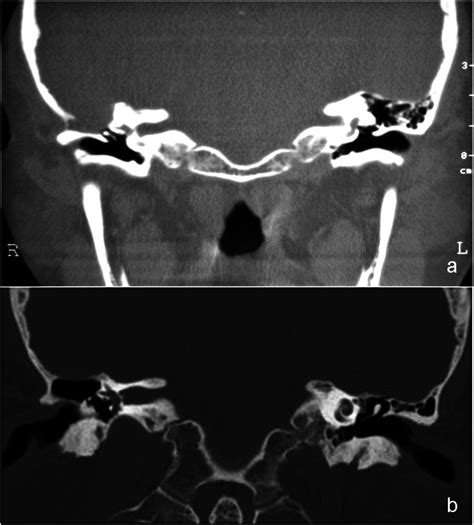 Pre-operative CT scan (a) showing a bony dehiscence of the tegmen in a... | Download Scientific ...