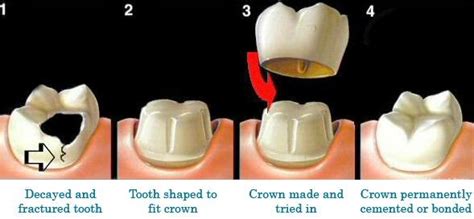 Omni Dental Group: Crowns: An Overview