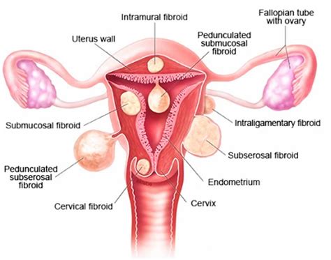 Myomectomy procedure risks, recovery time & pregnancy after myomectomy