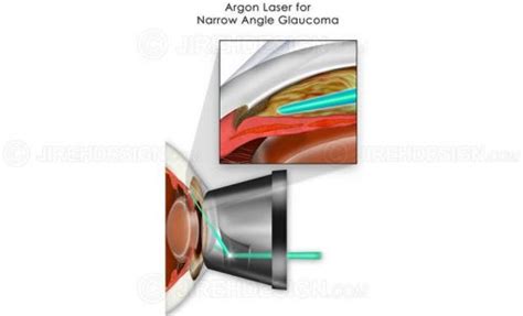 Argon laser for glaucoma - #SUG0005 | Stock eye images