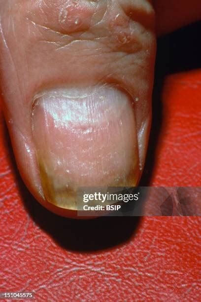 Inverse Psoriasis Photos and Premium High Res Pictures - Getty Images