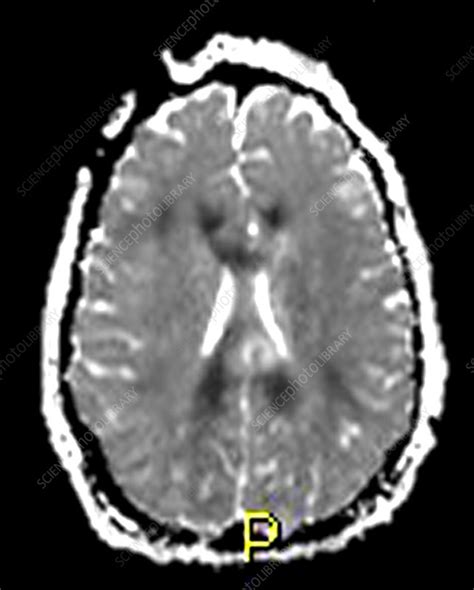 Severe Traumatic Brain Injury, MRI - Stock Image - C027/1728 - Science Photo Library