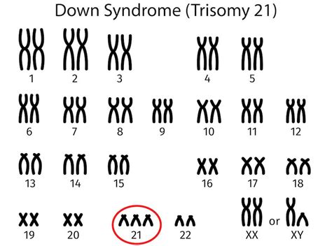 Are there ways to prevent or cure Down Syndrome? - The Tech Interactive