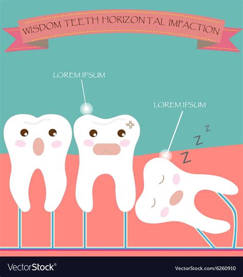 Wisdom teeth horizontal impaction Royalty Free Vector Image