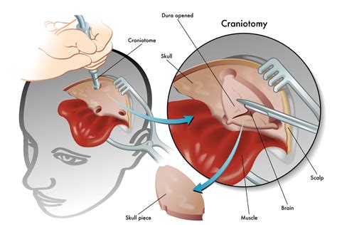 Craniotomy | Gillette Children's