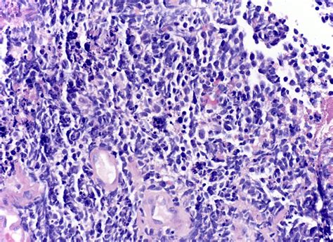 Lung Carcinoma Histology