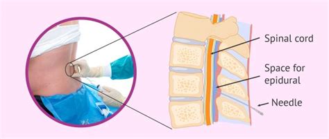 Epidural Anesthesia During Labor: Benefits & Side Effects