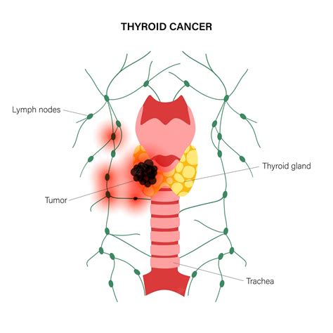 Premium Vector | Thyroid cancer stages