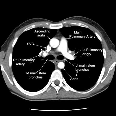 Thorax Radiologic Anatomy | Medical radiography, Radiology, Radiology ...