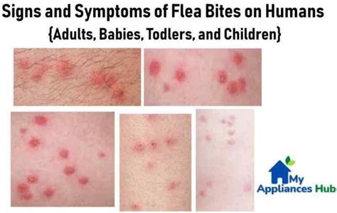 Flea Bites on Humans: What Do Fleabites Symptoms Really Look Like?