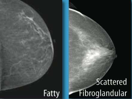 What does Scattered Fibroglandular Densities Mean? | Dentgap