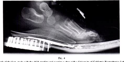 Talipes Calcaneovalgus | Semantic Scholar