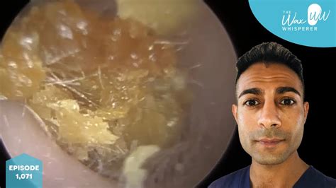 1,071 - Fully Blocked Dry Ear Wax Removal - YouTube