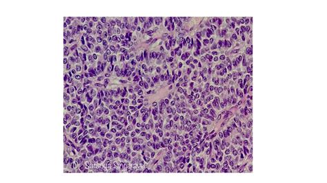 GRANULOSA CELL TUMOR- OVARY - Pathology Made Simple