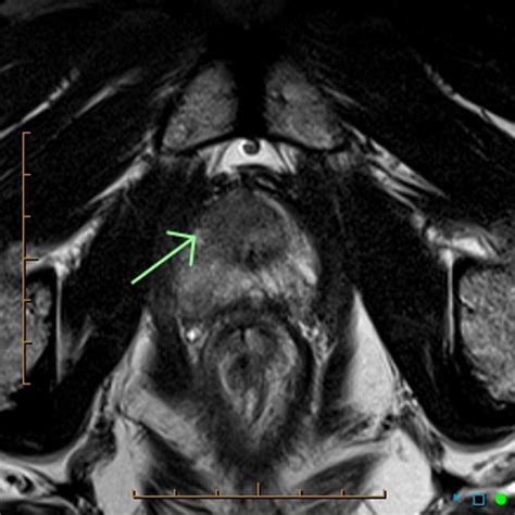 Prostate cancer MRI - wikidoc