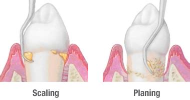 Perio Scaling: Treating a Creepy Problem - Gum Disease