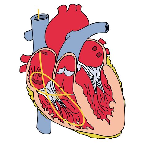 Transvenous Cardiac Pacing Pitfalls | Resus Review