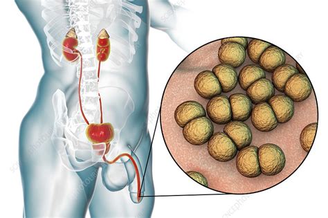 Gonorrhoea infection in male, illustration - Stock Image - F022/8360 ...