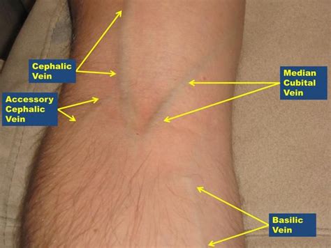 Phlebotomy Technique: Approach Considerations, Phlebotomy, Complications | Nurse, Phlebotomy ...