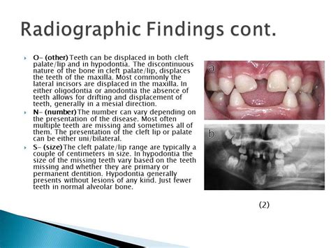 Ectodermal Dysplasia Teeth