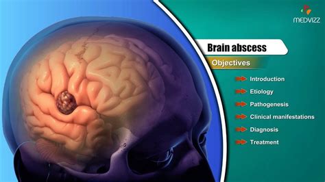 Brain abscess : Etiology , Pathogenesis , Clinical manifestations , Diag... | Manifestation ...